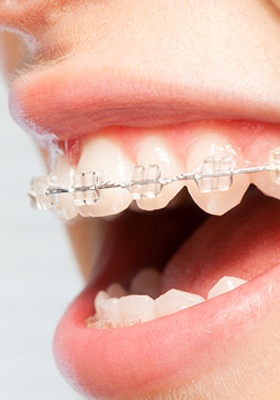 Someone smiling with clear ceramic braces