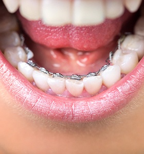 Bottom teeth with lingual braces 