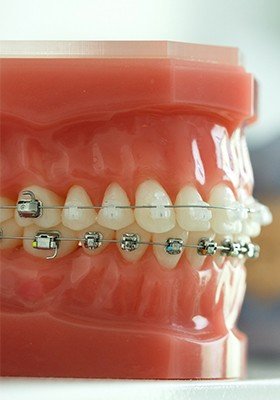 Model smile with bracket and wire braces