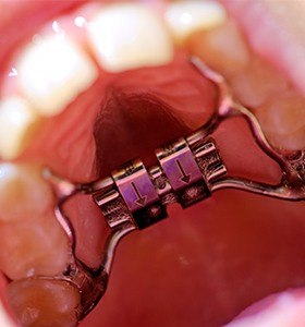 Closeup of smile with palatal expander