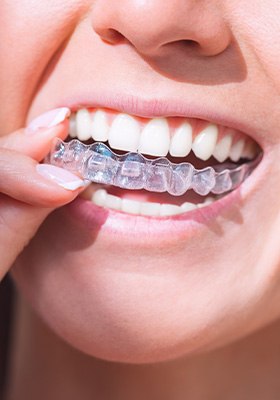 A woman placing an Invisalign tray over her teeth