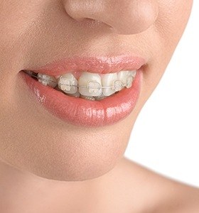 Closeup of teeth with ceramic braces