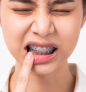 A young person pointing to their mouth and cringing in pain while wearing braces 
