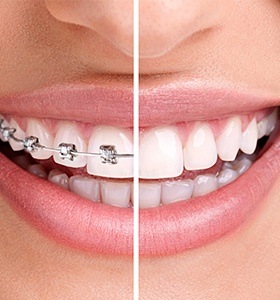 Closeup of smile with and without braces