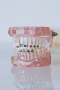 Model of traditional braces
