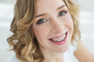 Blonde woman with braces looking up and smiling