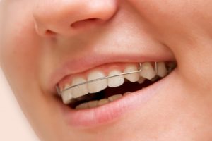 a woman smiling while wearing her retainer