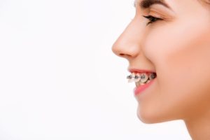 profile of a young woman with an overbite wearing braces in front of white background