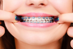 Woman pulling back her lips to reveal metal braces
