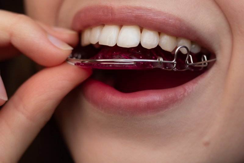 A woman putting an old retainer in her mouth